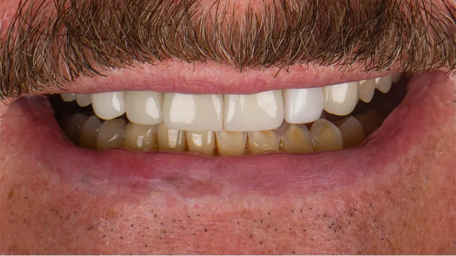 Before smile transformation, case 33 — Tillinger Dental, Miami Beach