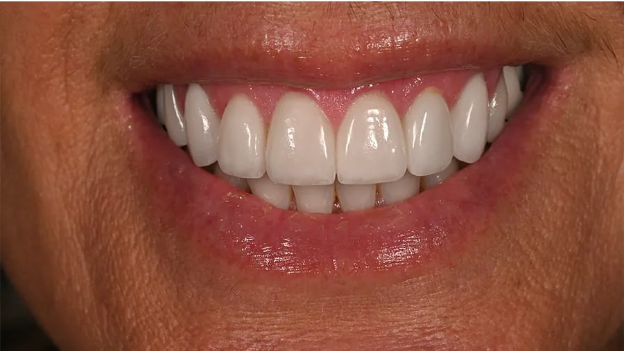 After smile transformation with porcelain restorations, case 36 — Tillinger Dental, Miami Beach