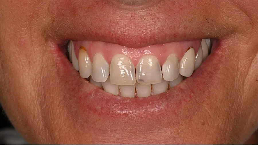 Before smile transformation, case 36 — Tillinger Dental, Miami Beach