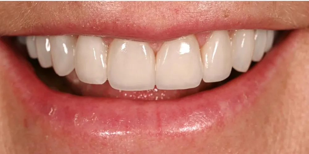 After smile transformation with porcelain restorations, case 37 — Tillinger Dental, Miami Beach