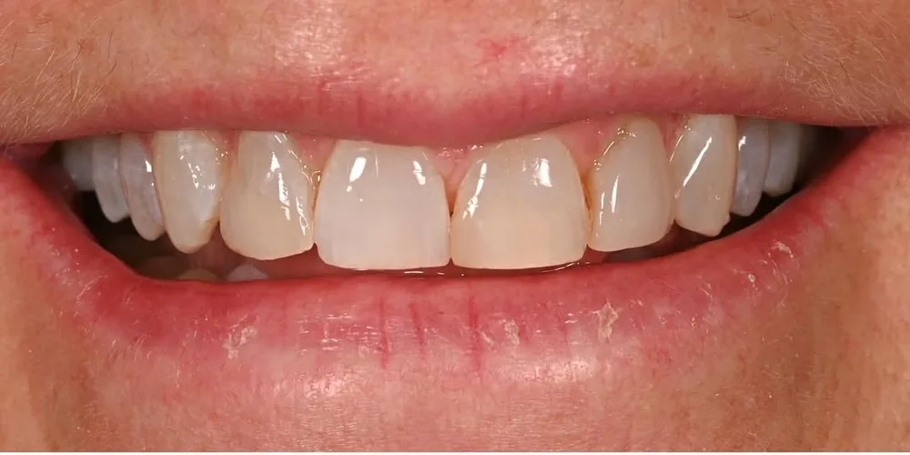 Before smile transformation, case 37 — Tillinger Dental, Miami Beach