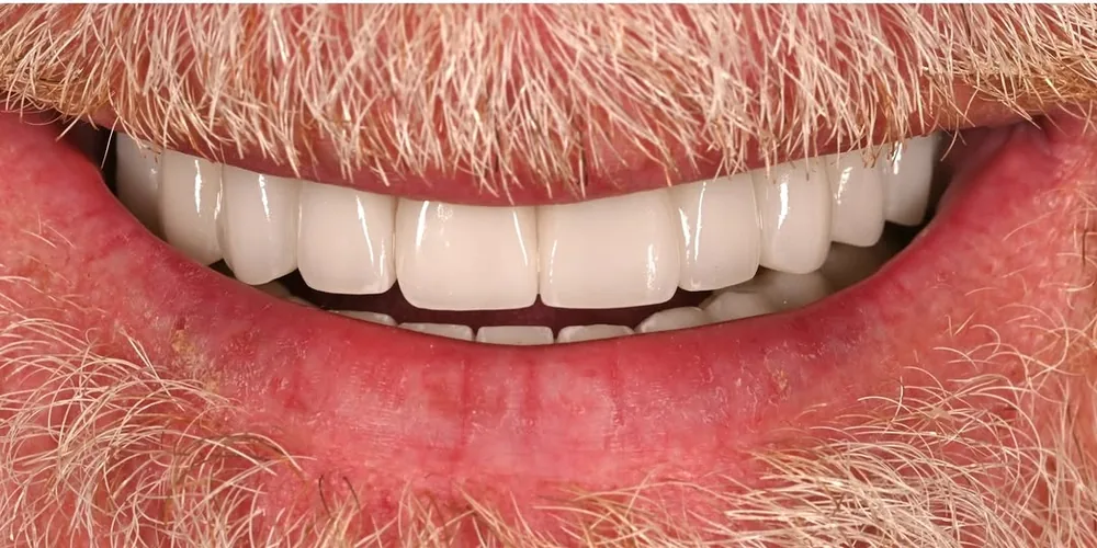 After smile transformation with porcelain restorations, case 39 — Tillinger Dental, Miami Beach