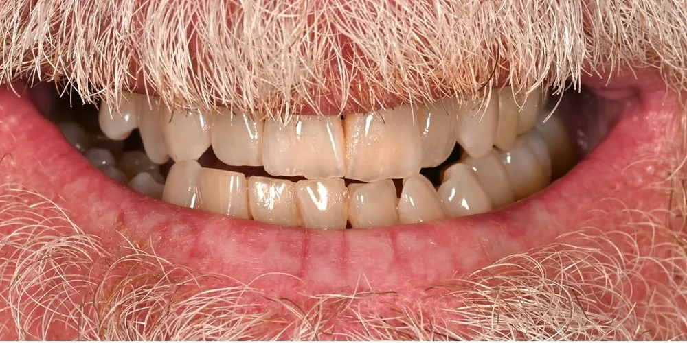 Before smile transformation, case 39 — Tillinger Dental, Miami Beach