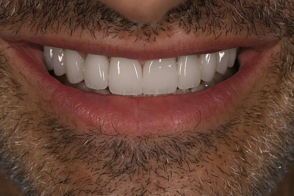 After smile transformation with porcelain restorations, case 40 — Tillinger Dental, Miami Beach