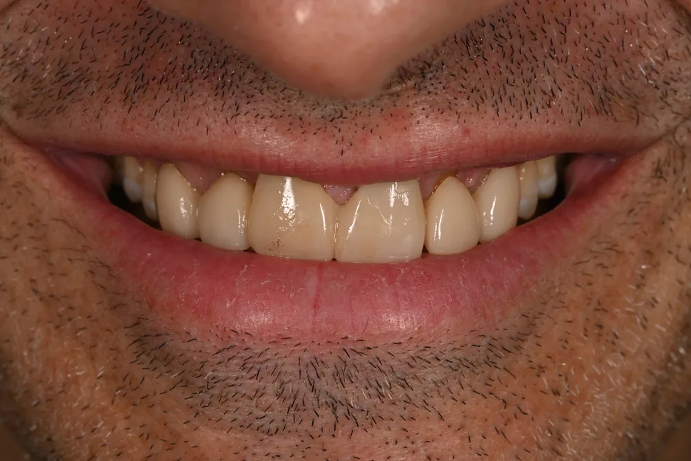 Before smile transformation, case 40 — Tillinger Dental, Miami Beach